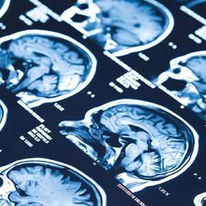Understanding Epilepsy